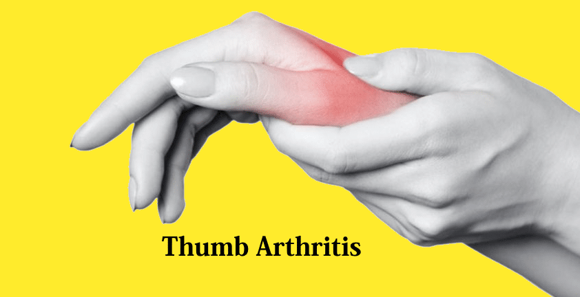 thumb-carpometacarpal-joint-arthritis-the-ultimate-guide-i-noesis