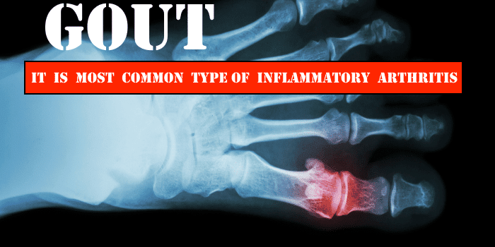 Gout