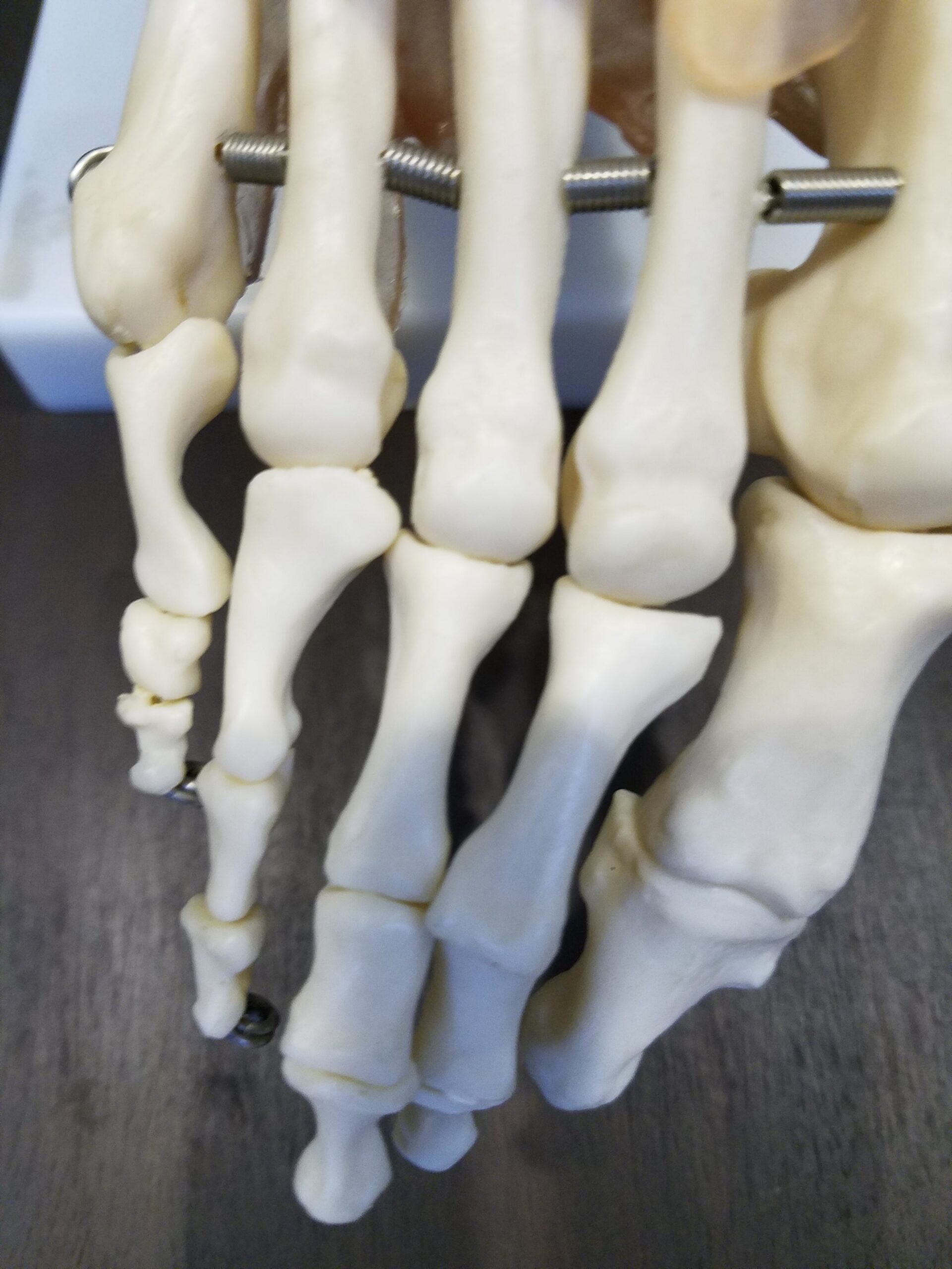 34 foods which lower uric acid levels in Metatarsophalangeal Joint of Left Little or 5th Toe joint Arthritis