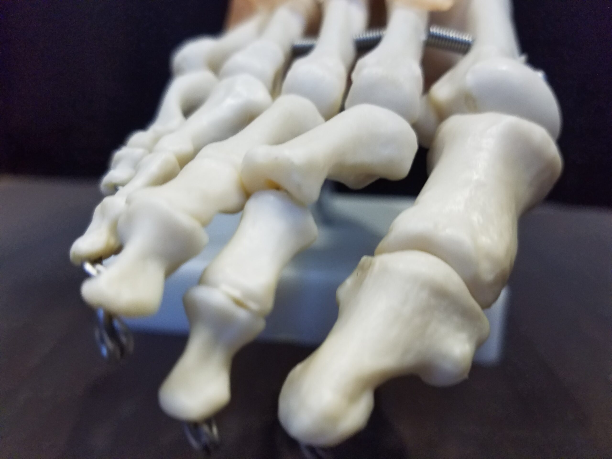 34 foods which lower uric acid levels in Distal Interphalangeal Joint of Left Ring Toe Arthritis